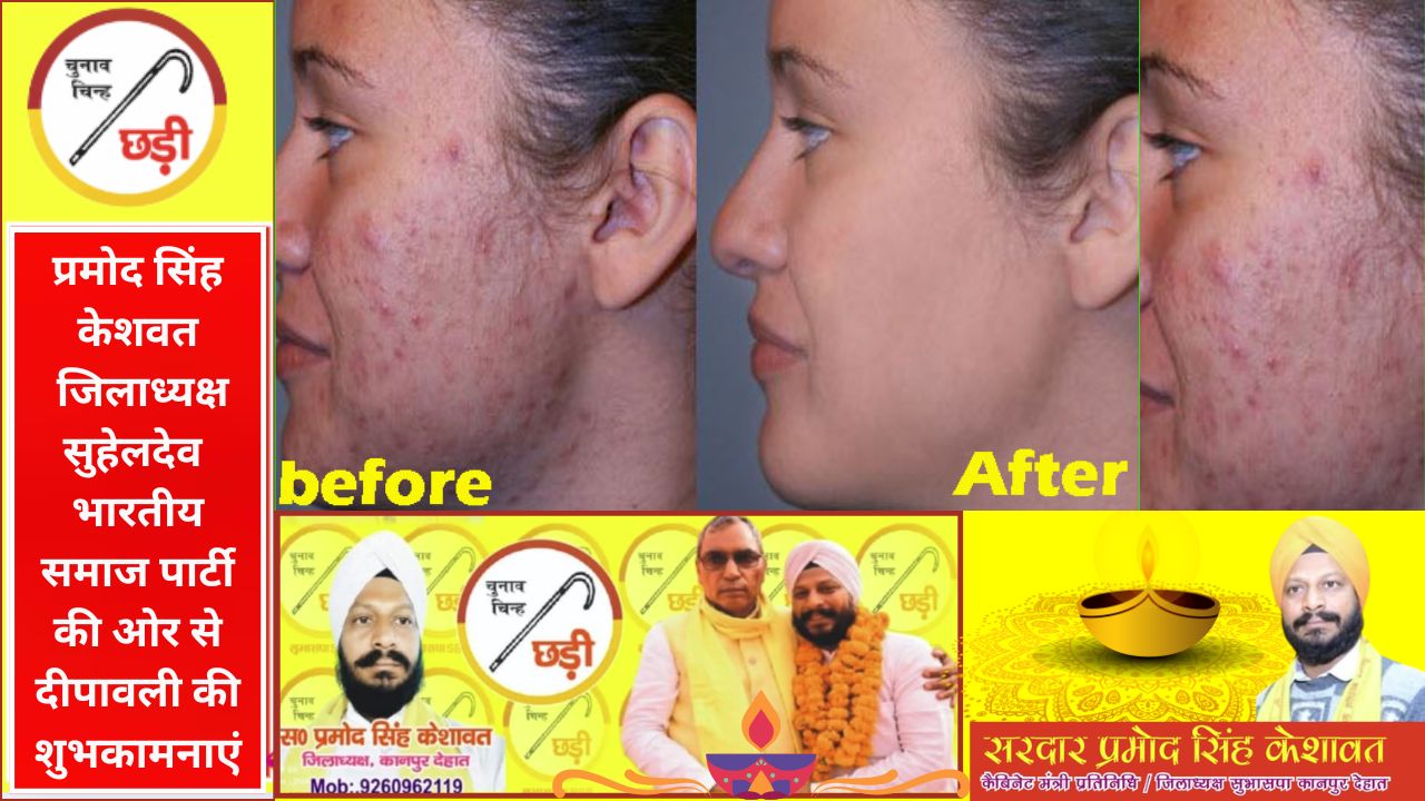 एक्ने और पिंपल्स से निज़ात: सैलिसिलिक एसिड सीरम से पाएं साफ और स्मूद त्वचा