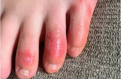 Ungli Me Khujli Ho To Kya Kare:  सर्दियों में उंगलियों की खुजली क्यों बढ़ जाती है? जानिए कारण, घरेलू उपाय और बचाव